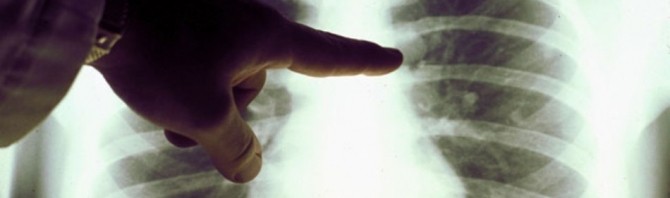 cancer-pulmonar