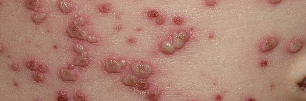 varicela35