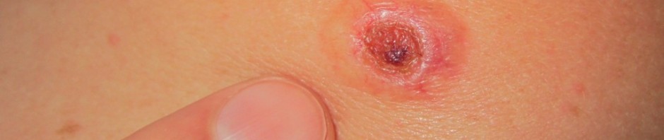 cancer piele