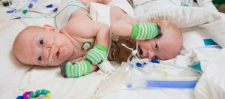 operatie frati siamezi