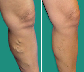 Picioare umflate vs. pleoape umflate (ce ne pot indica edemele)