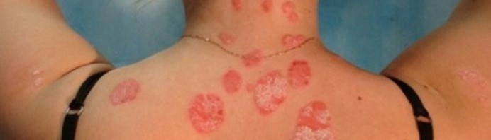 psoriazis