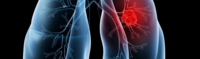 cancer pulmonar