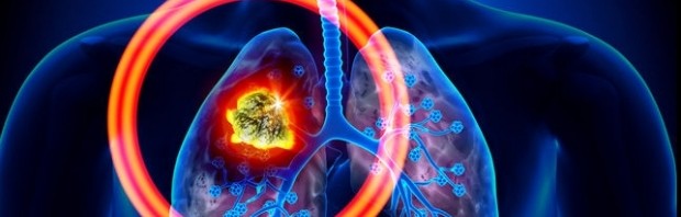 cancer pulmonar