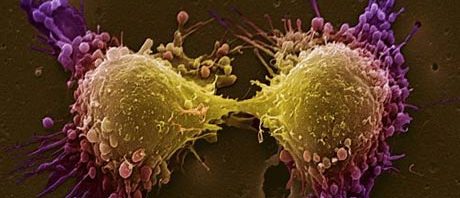 celule canceroase