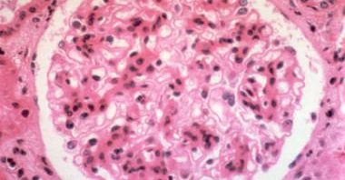 lupus