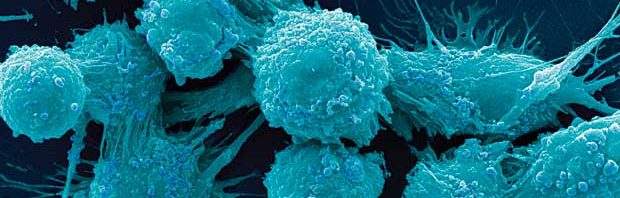 cancer prostata