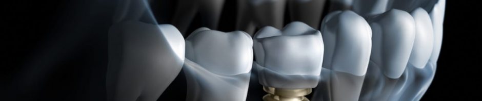 implant dentar