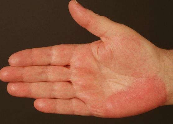 psoriasis-of-the-hands-and-feet-symptoms-diagnosis-treatment